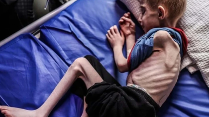 গাজায় শিশুরা কঙ্কালসার, অনাহারে মৃত্যু ৬৬ জনের