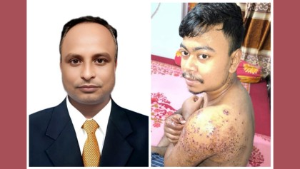 গুলিবিদ্ধ নিরবের চিকিৎসা খরচ চালাবেন নজরুল বিশ্ববিদ্যালয়ের কর্মচারী 