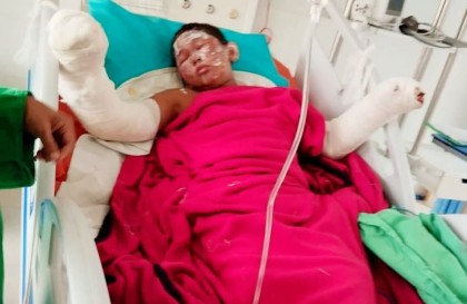 উত্তরায় স্কুলে আগুনে দগ্ধ আবিদ, উন্নত চিকিৎসার দাবি পরিবারে