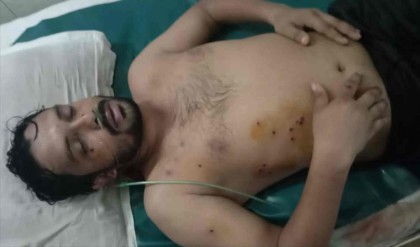 ছররা গুলিতে শরীর ঝাঁঝরা, যন্ত্রণা নিয়েই বেঁচে আছেন আলাউদ্দিন