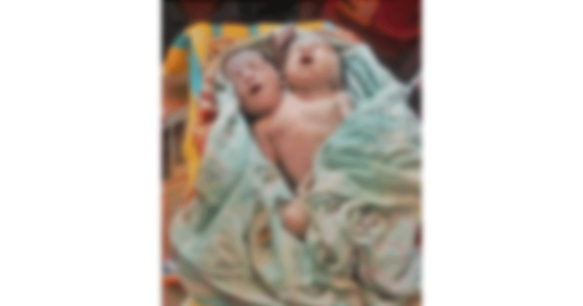 নওগাঁয় দুই মাথাওয়ালা নবজাতকের জন্ম, এক ঘণ্টার মধ্যেই মৃত্যু