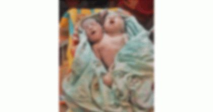 নওগাঁয় দুই মাথাওয়ালা নবজাতকের জন্ম, এক ঘণ্টার মধ্যেই মৃত্যু