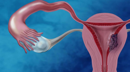 অনিয়মিত ঋতুস্রাব হতে পারে জরায়ুর ক্যানসারের লক্ষণ