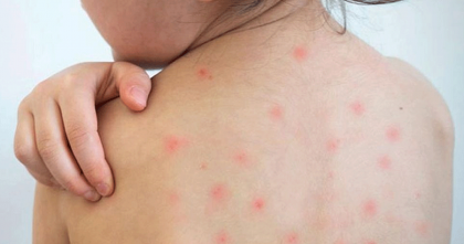 হামের উপসর্গ নিয়ে আরও ১০ শিশুর মৃত্যু