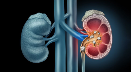 কিডনিতে পাথর তৈরি করে যেসব খাবার