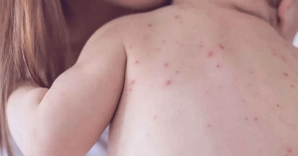 হাম ও হামের উপসর্গ নিয়ে ৪ শিশুর মৃত্যু