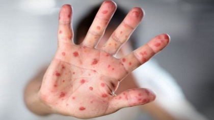 হামের প্রাদুর্ভাব: ২৪ ঘণ্টায় আরও ৭ মৃত্যু, সংক্রমণ বেড়েই চলেছে