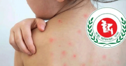 হাম উপসর্গে আরও ১১ শিশুর মৃত্যু