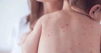 হামে আরও দুই শিশুর মৃত্যু 